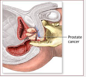 prostate cancer treatment